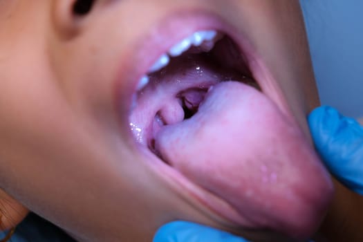 Close-up inside the oral cavity of a healthy child with beautiful rows of baby teeth. Young girl opens mouth revealing upper and lower teeth, hard palate, soft palate, dental and oral health checkup.