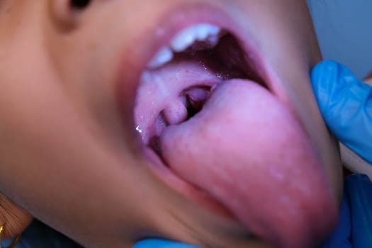 Close-up inside the oral cavity of a healthy child with beautiful rows of baby teeth. Young girl opens mouth revealing upper and lower teeth, hard palate, soft palate, dental and oral health checkup.