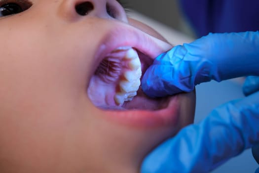 Close-up inside the oral cavity of a healthy child with beautiful rows of baby teeth. Young girl opens mouth revealing upper and lower teeth, hard palate, soft palate, dental and oral health checkup.