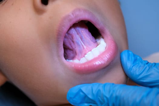 Close-up inside the oral cavity of a healthy child with beautiful rows of baby teeth. Young girl opens mouth revealing upper and lower teeth, hard palate, soft palate, dental and oral health checkup.