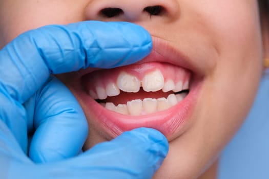 Close-up inside the oral cavity of a healthy child with beautiful rows of baby teeth. Young girl opens mouth revealing upper and lower teeth, hard palate, soft palate, dental and oral health checkup.