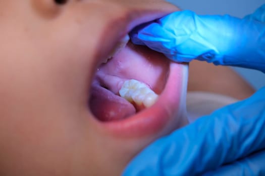 Close-up inside the oral cavity of a healthy child with beautiful rows of baby teeth. Young girl opens mouth revealing upper and lower teeth, hard palate, soft palate, dental and oral health checkup.