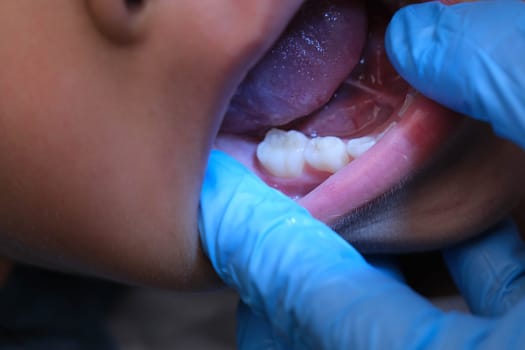 Close-up inside the oral cavity of a healthy child with beautiful rows of baby teeth. Young girl opens mouth revealing upper and lower teeth, hard palate, soft palate, dental and oral health checkup.