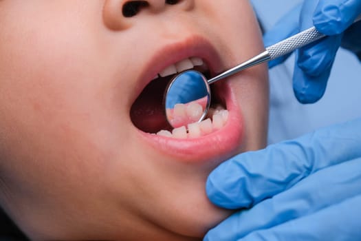 Close-up in the oral cavity of a healthy child with beautiful white teeth. Young girl opens her mouth to reveal healthy teeth, hard and soft palate. Dental and oral health check