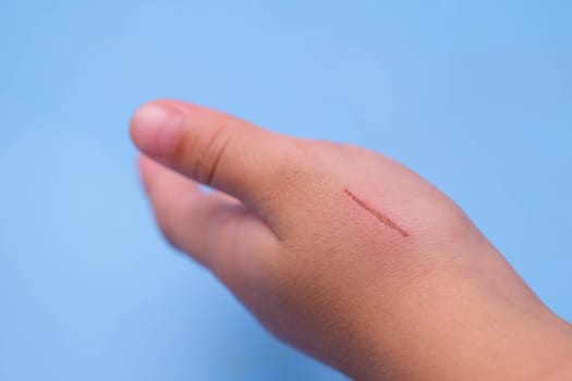 Close-up of a scratch on the skin of a child's hand. Wounds or abrasions on the child's hands