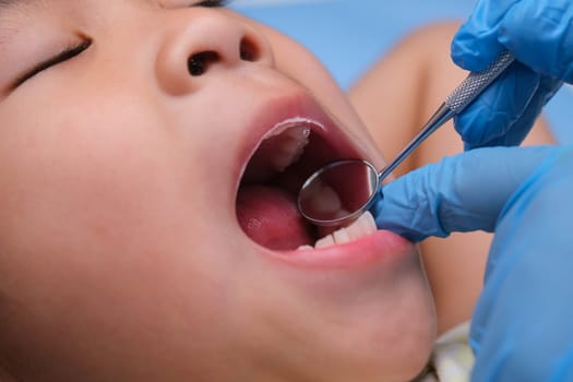 Close-up in the oral cavity of a healthy child with beautiful white teeth. Young girl opens her mouth to reveal healthy teeth, hard and soft palate. Dental and oral health check