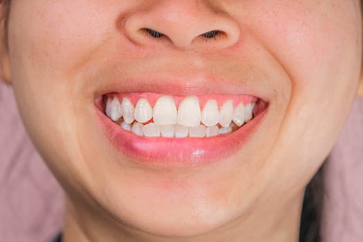 Close-up of front view of happy asian woman smiling broadly revealing her beautiful white teeth isolated on pink background.