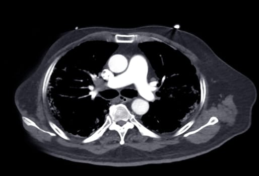 CTA pulmonary arteries 3D rendering showing branch of pulmonary artery