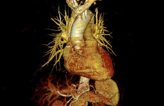 CTA of the aorta with stent-grafting in patient Abdominal aortic aneurysm.