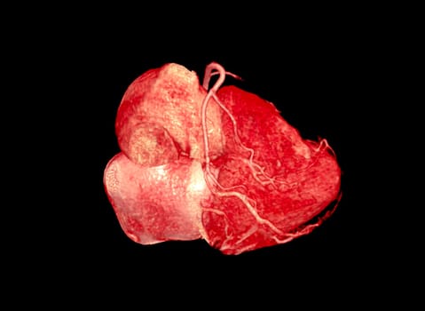 CTA Coronary artery 3D rendering image.