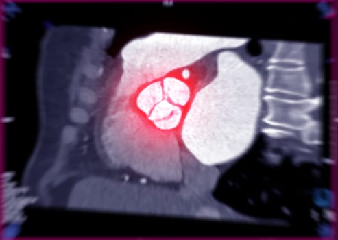 CTA of the aorta showing aortic valve.