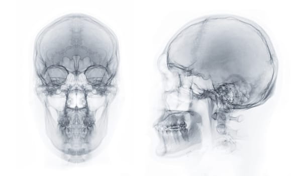 X-ray image of Human Skull AP and Lateral view for diagnosis skull fracture isolated on Black Background.