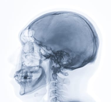 x-ray image of Human Skull lateral view for diagnosis skull fracture isolated on Black Background.