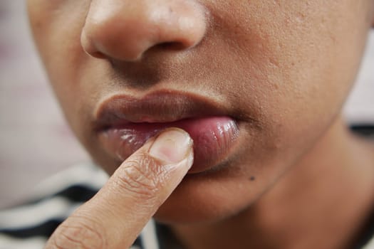 young man applying moisturising lip balm on lips.