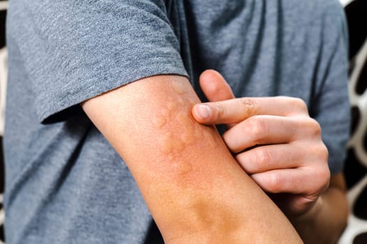 Skin rash and swelling on man arm, immunizations prevent infectious disease in human