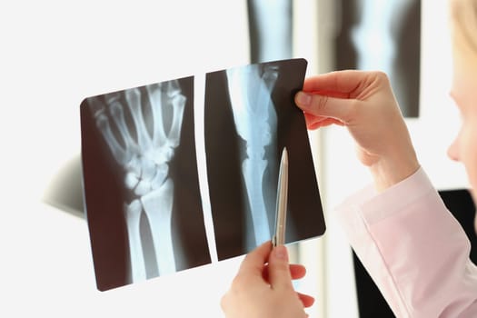 female doctor looks at x-ray of a arm injury in hospital. Sequelae of hand injuries and arthritis