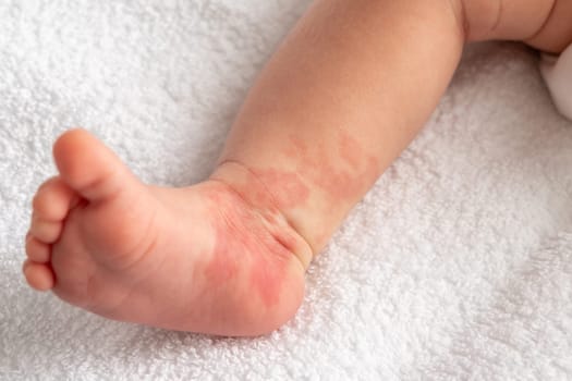 Infant Hemangioma red birthmark on the leg of newborn baby