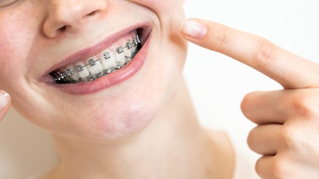 Close-up portrait of a young woman pointing at a smile with braces on her teeth