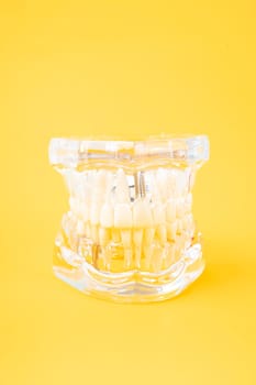 Human jaw or Acrylic dentures model with implants on yellow background.