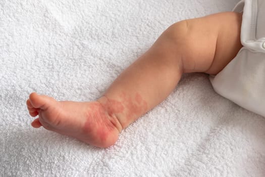 Infant Hemangioma red birthmark on the leg of newborn baby