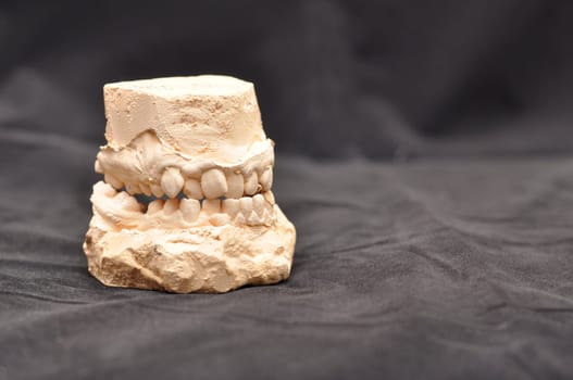 Plaster model or cast of human teeth. Strongly crooked teeth, deformed jaw.