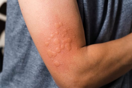 Skin texture, allergy shot, weeds, reaction Allergy symptoms Selective focus