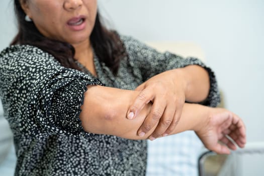 Asian woman patient touch and feel pain her elbow and arm, healthy medical concept.
