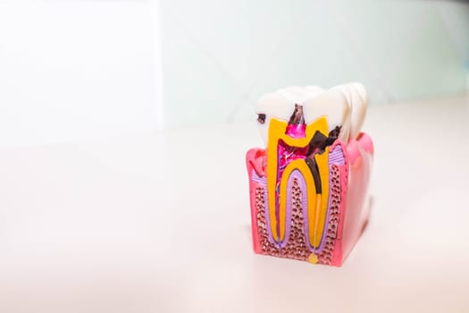 tooth model with caries, tooth decay in dentist's office. Healthy teeth concept . Big tooth model with details on the nerve, dentin,