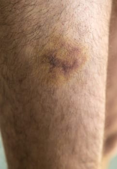 a bruise on a man's leg. Selective focus. people.
