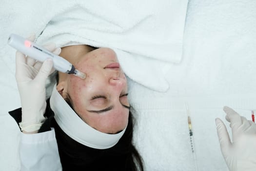Top view of female patient having microneedling procedure applied on her face. Microneedling. Dermapen. Esthetician. Health and beauty.