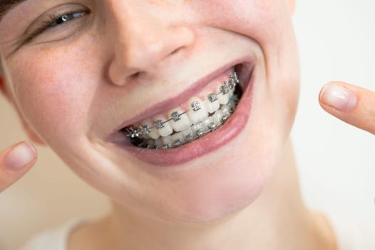Close-up portrait of a young woman pointing at a smile with braces on her teeth