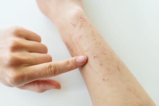 The doctor examines the hand, the person is scratched all over, dry skin on the hand, wounds on the hand, scars, psoriasis vulgaris, eczema or other skin diseases. Miscellaneous autoimmune genetic disease