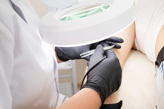 Dermatologist Doing Hair Removal Procedure With Electrolysis On Hand Of White Young Patient, Electric Epilation In Beauty Salon. Horizontal Plane. Authentic High quality photo