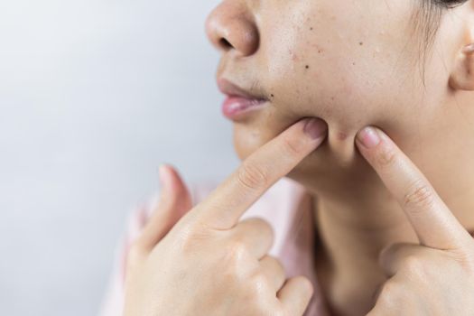 Young woman with acne problem on gray background