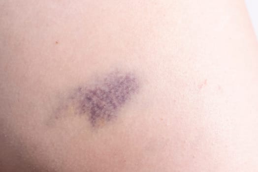 Closeup Blue Purple Hematoma, Bruise On Thigh, Hip After Trauma, Fall. Horizontal plane. Clotted Blood, Injury On Human Body Concept. High quality photo