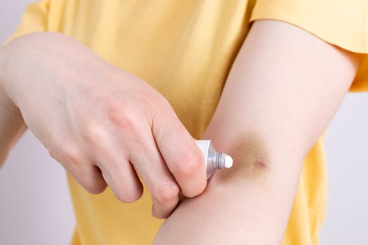 Closeup Female Person Applies Healing Cream, Ointment On Hematoma, Bruise After Injection, Blood Sampling From Metal Tube. Injury Treatment, Cure. Post-injection phlebitis. Horizontal plane.
