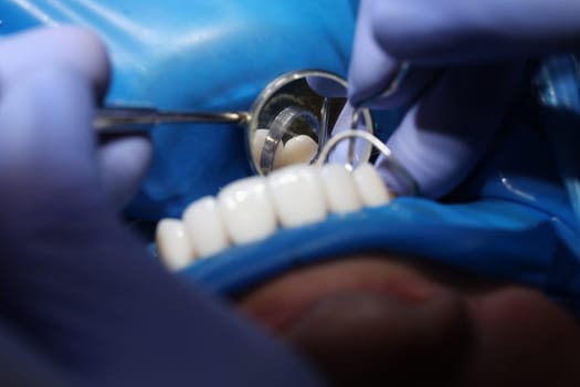 Doctor dentist installing veneers on patient teeth using metal tools closeup. Dental care concept