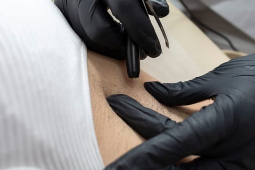 Closeup Dermatologist Removing Hair On Patient's Armpits With Electrolysis Procedure, Electric Epilation In Beauty Salon. White Customer Is Lying On Couch. Horizontal Plane. Hair Removal Treatment.