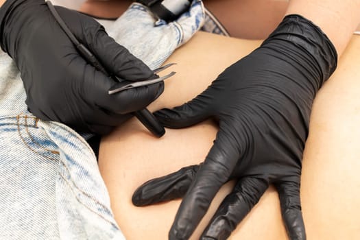 Hirsutism. Cropped Dermatologist Removes Hair On Woman's Belly, Abdomen With Electrolysis Procedure, Electric Epilation In Beauty Salon. Horizontal Plane. Authentic Photo