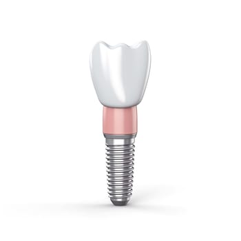 Close up of dental teeth implant. 3D rendering