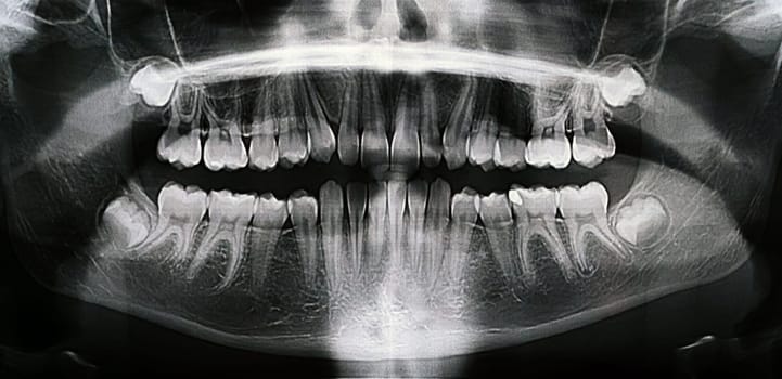 Panoramic X-ray of the jaw. X-ray of the teeth of a 12-year-old girl.