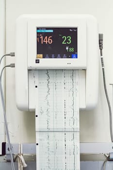 Close up of a fetal monitor or non stress test printing baby heartbeats, electrocardiograph and mother uterine contraction in Labor and delivery room at hospital.