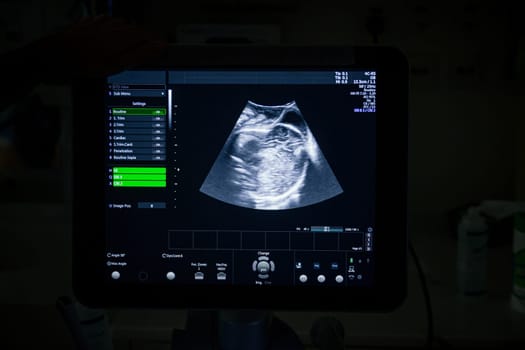 Medical ultrasound machine with a 4D image in a Labor and delivery room at a hospital.