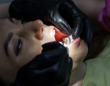 Installing a retainer after wearing braces. The process of removing braces.Beautiful woman in dental chair during procedure of installing braces to upper and lower teeth. Dentist and assistant working