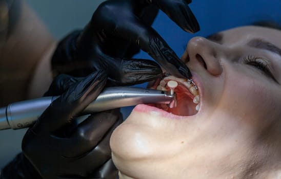 The process of removing braces.Beautiful woman in dental chair during procedure of installing braces to upper and lower teeth. Dentist and assistant working together, dental tools in their hands.