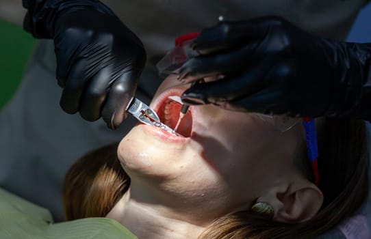 The process of removing braces. A beautiful woman in protective glasses in a dental chair during the procedure of removing braces from teeth. Dentist and assistant working.