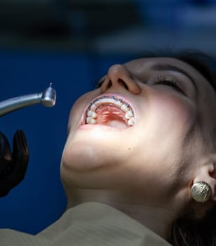 Installing a retainer after wearing braces. The process of removing braces.Beautiful woman in dental chair during procedure of installing braces to upper and lower teeth. Dentist and assistant working