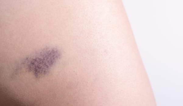 Closeup Blue Purple Hematoma, Bruise On Thigh, Hip After Trauma, Fall. Horizontal plane. Clotted Blood, Injury On Human Body Concept. Copy Space For Text. High quality photo