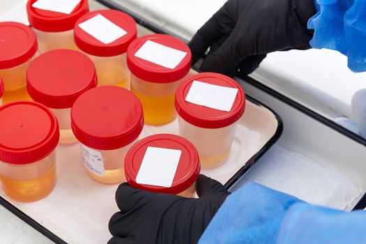 Urine analysis in laboratory. Preparation of urine samples in the hospital for the study