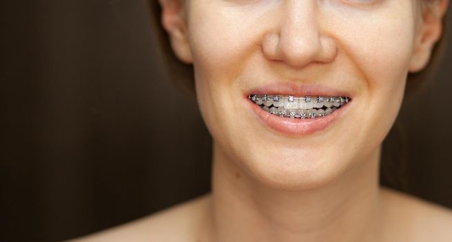 The smile of a young and beautiful girl with braces on her white teeth. Straightening of crooked teeth with the help of a bracket system. Malocclusion. Dental care. Smooth teeth and a beautiful smile